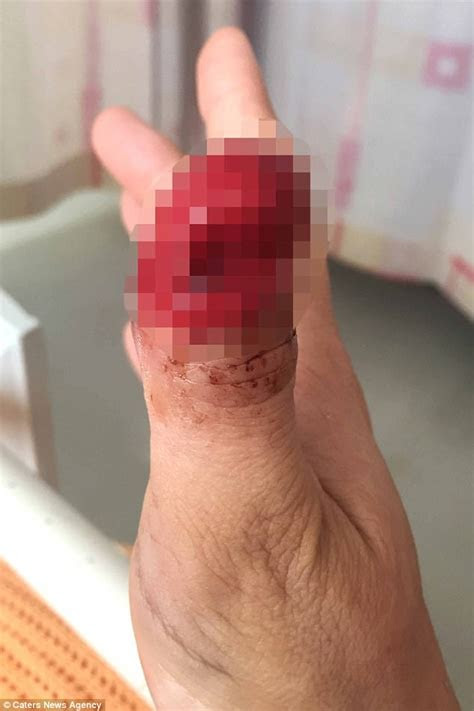 kent mum loses tip  thumb  ripping  acrylic nail