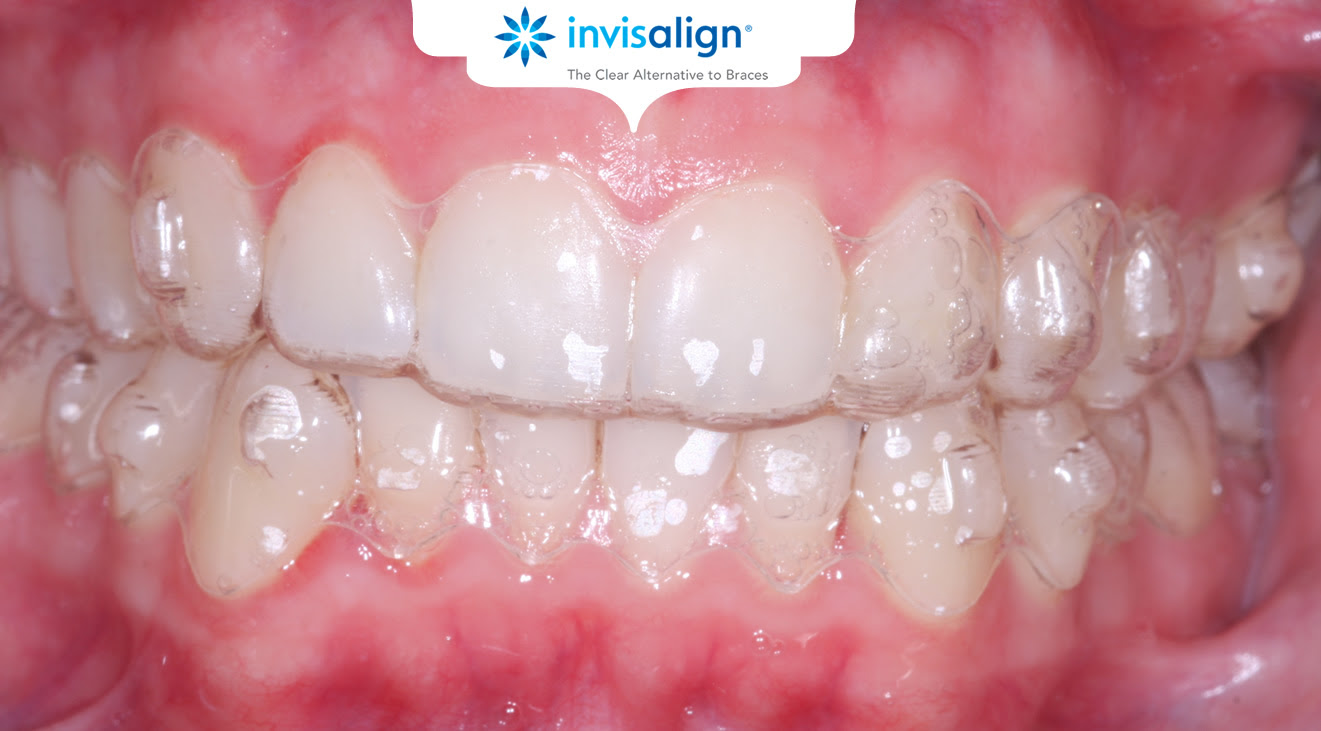 How to Straighten Teeth Without Braces -