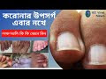 করোনার নতুন উপসর্গ এবার নখে, লক্ষণগুলি কি কি জেনে নিন | Covid Nails Symptoms