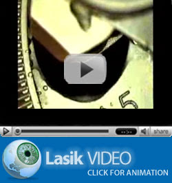 Click to see video of Lasik.