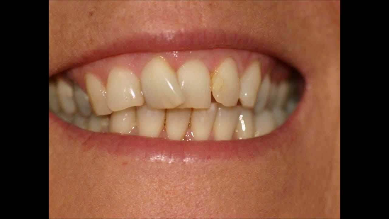 Overlapping teeth invisalign