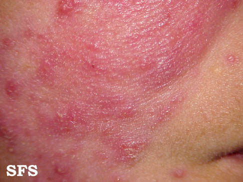 Skin Discoloration, Causes, Pictures of Abnormal Skin Colors 
