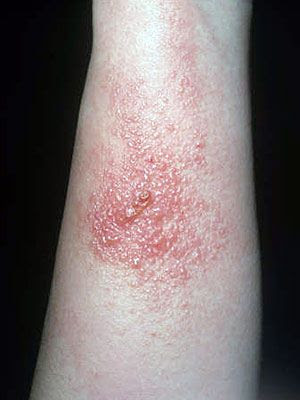 poison ivy plant rash. treating a poison ivy rash