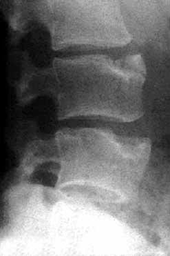 Maladie de Scheuermann - Vulgaris Mdical