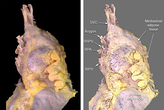 Mesothelioma And Visceral Pleura : Pleural cavity: Anatomy and clinical aspects | Kenhub : Mesothelioma of the thorax is a malignant neoplasm that involves the parietal pleura to a greater extent than the visceral pleura (,1).
