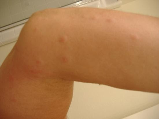 bed bug bites scabies and infection - Picture of Bakersfield ...