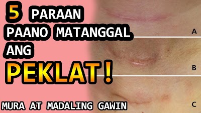 Paano Tanggalin Ang Mga Peklat Sa Binti