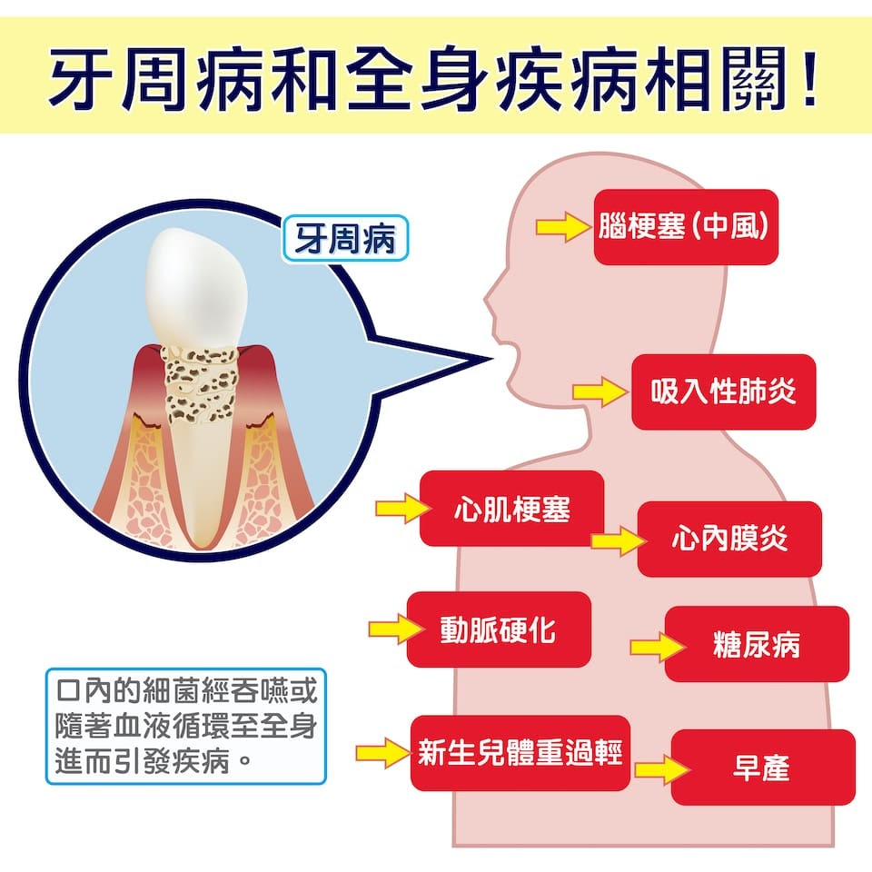 牙周病莫輕忽 不及早治療恐影響全身健康 葉立維醫師 牙周專科醫師