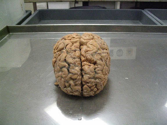 The Brains Of People With Walking Corpse Syndrome Might Actually Be Shutting Down Smart News Smithsonian Magazine
