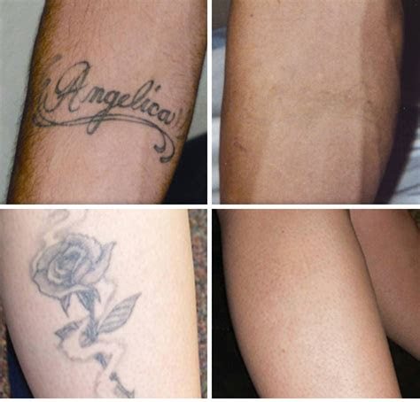 tattoo removal exhale body rejuvenation