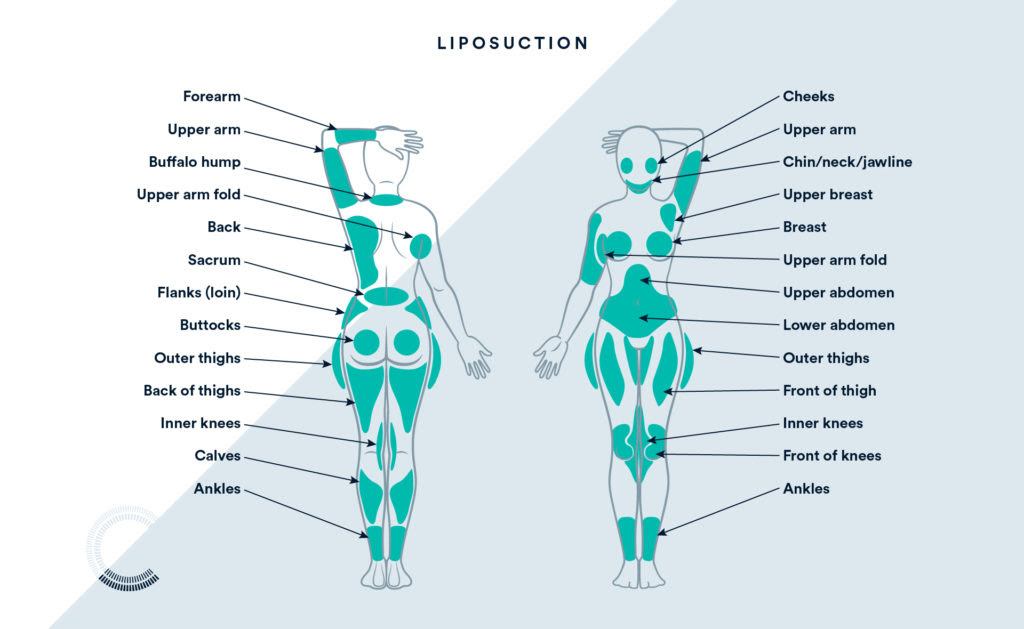 Where You Can Use Liposuction On The Body - Chart Attack