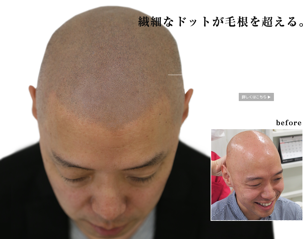 医療ヘアタトゥー 最高の薄毛対策 Spj エス ピー ジェイ