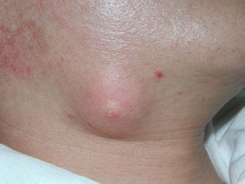 皮膚病 皮膚の病気 ３ 稲葉クリニック 杉並区皮膚科