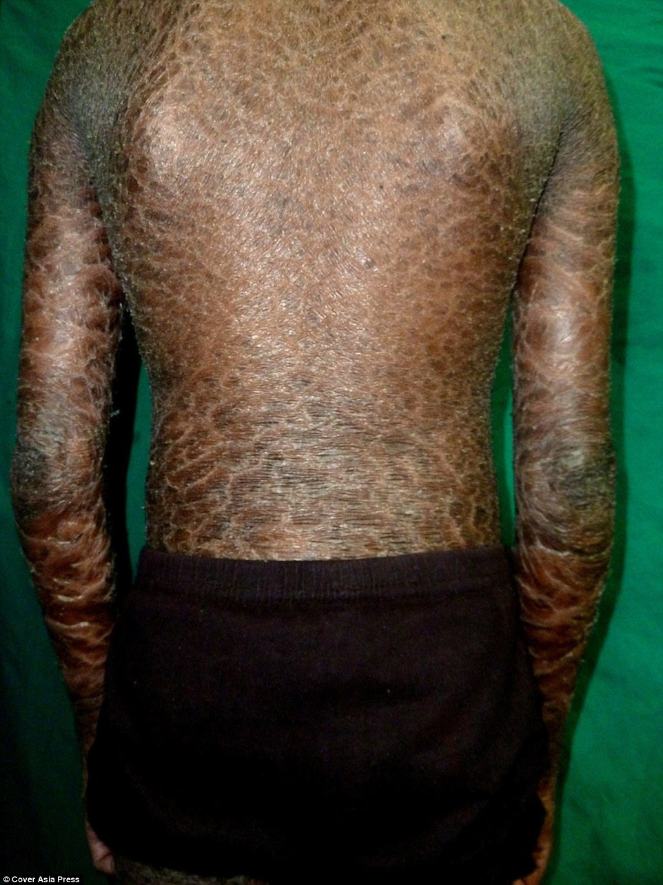 It is a rare skin disorder that appears at birth and remains with suffers for the rest of their lives