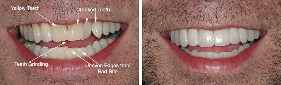 Straight Teeth without Braces