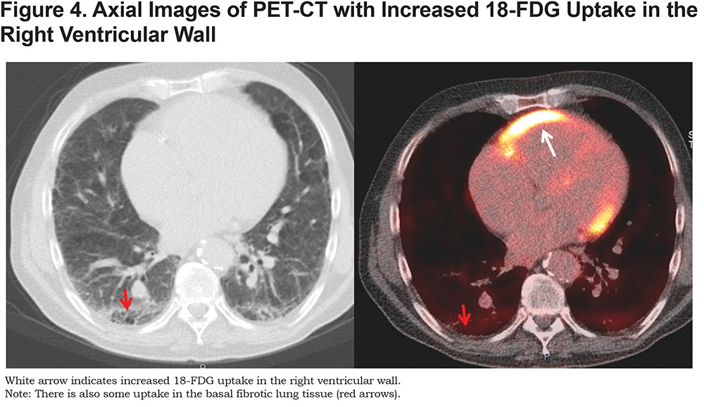 COPD Images: Emphysema & Fibrosis with Hypertension 