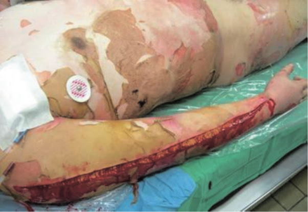 2 Emergency Care Of Burn D Ps
