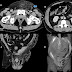 Fournier's Gangrene Images : Fournier's Gangrene Genital Infection - What to Know About ... / Fournier's gangrene is a rare form of necrotizing fasciitis that occurs on your genitals.