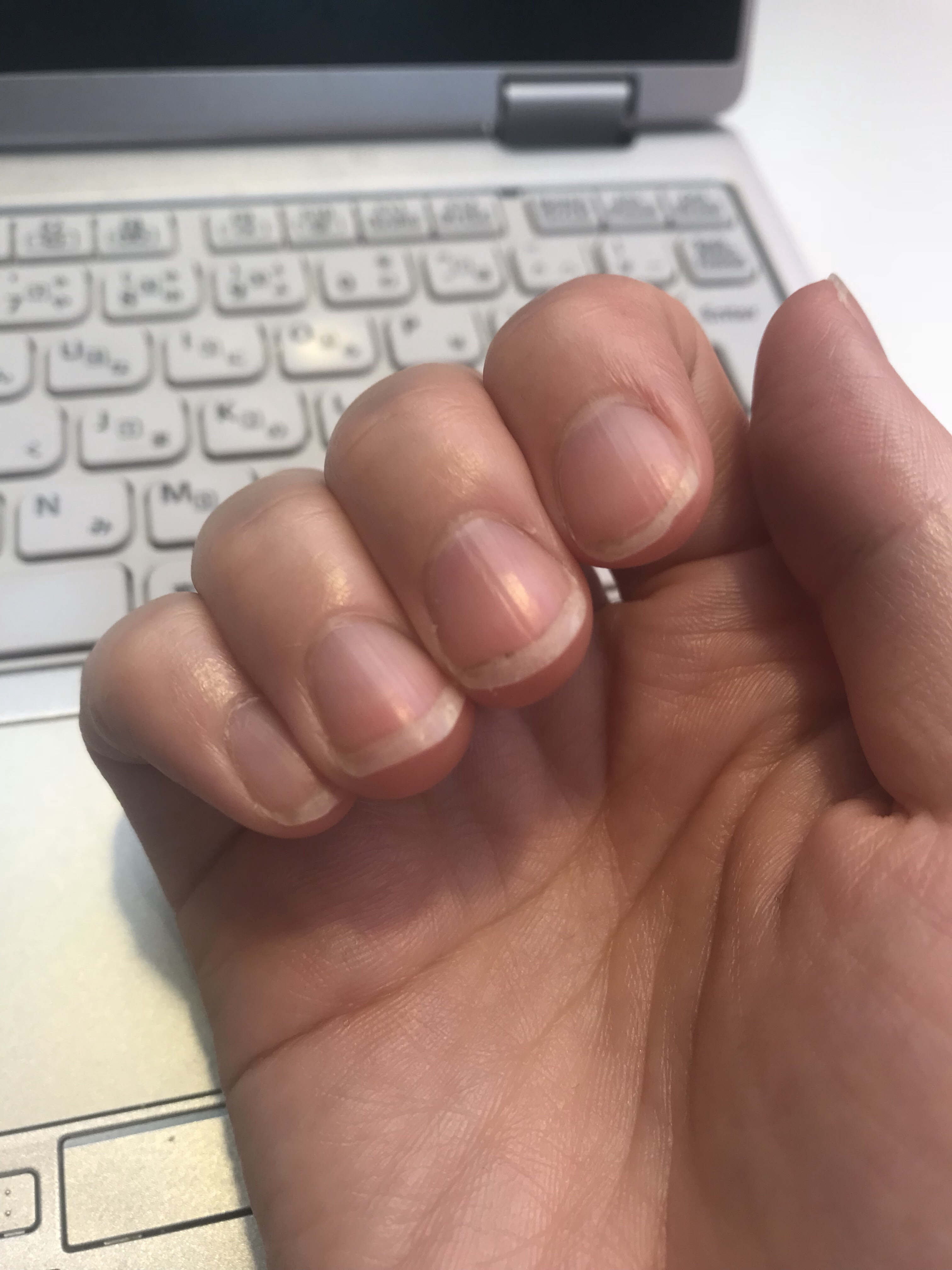 爪の形が悪いのでセルフ矯正を始めた話 ハイポニキウムって何 育て方や自宅矯正のコツ