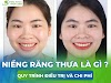 Quy trình và lợi ích của phương pháp niềng răng thưa