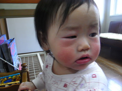 赤ちゃん まぶた の 腫れ 寝起きに突然片目が腫れた時に疑われる病気とその対処法を医師に聞いた Luismiguel Pt