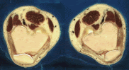 Section through Visible Human Male - knee, including patella (from Thigh subset)
