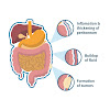 Pleural Mesothelioma Diagnosis / Pleural effusion - Libre Pathology / Also known as 'water on the lung,' pleural effusion occurs when liquid fills the space between the lungs and the chest wall.