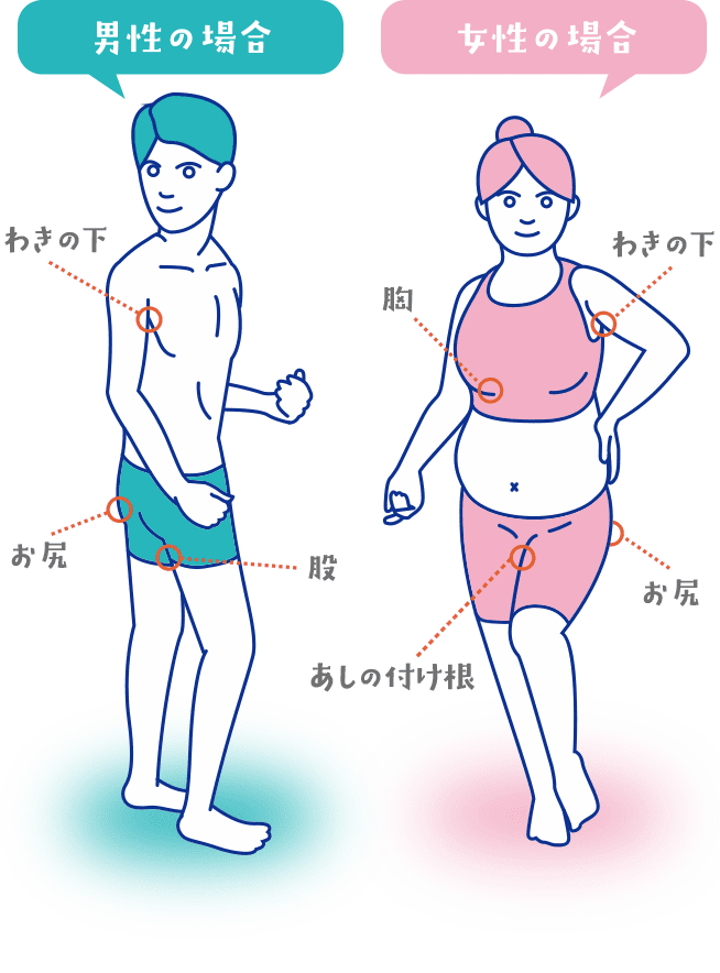 化膿性汗腺炎の症状 繰り返す痛いおでき Com 化膿性汗腺炎についての情報サイト