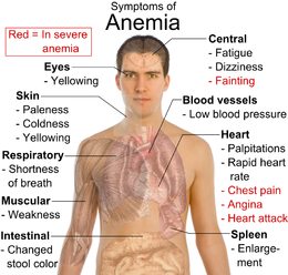 anemic