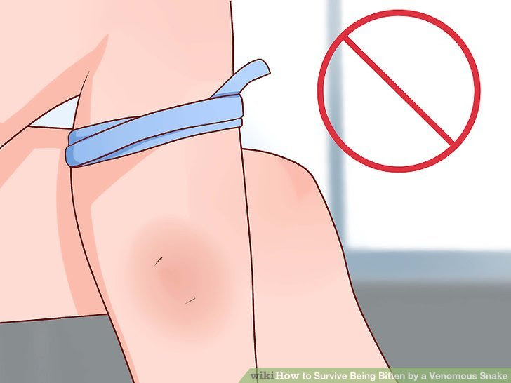 Survive Being Bitten by a Venomous Snake Step 12 Version 2.jpg