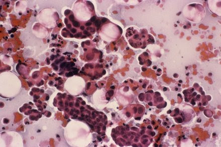 Cervical Cancer Taking Deadlier Toll in U.S. Than Had Been Thought