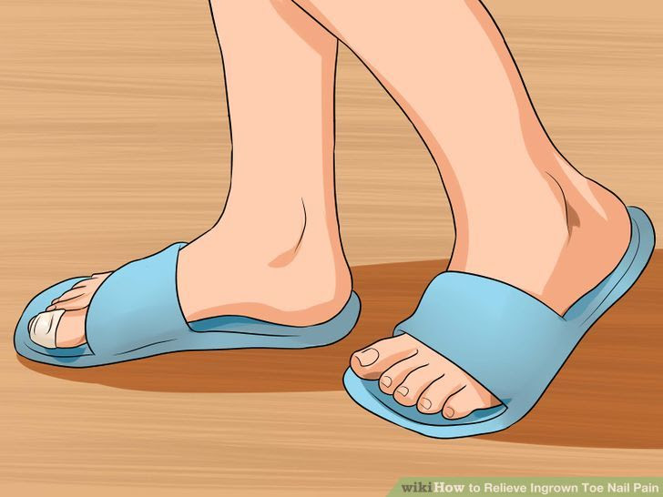 Relieve Ingrown Toe Nail Pain Step 12 Version 3.jpg
