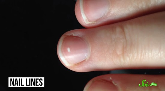 爪に表れる白い線は病気のサイン というのは本当か ログミーbiz