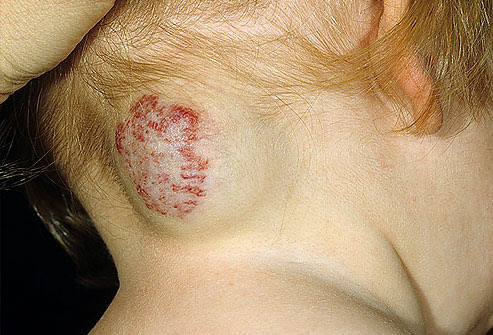  head or neck. Most disappear by puberty. A combination of cavernous and 