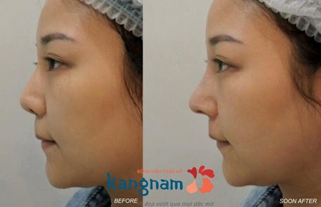 nâng mũi cấu trúc 4D siêu âm-10