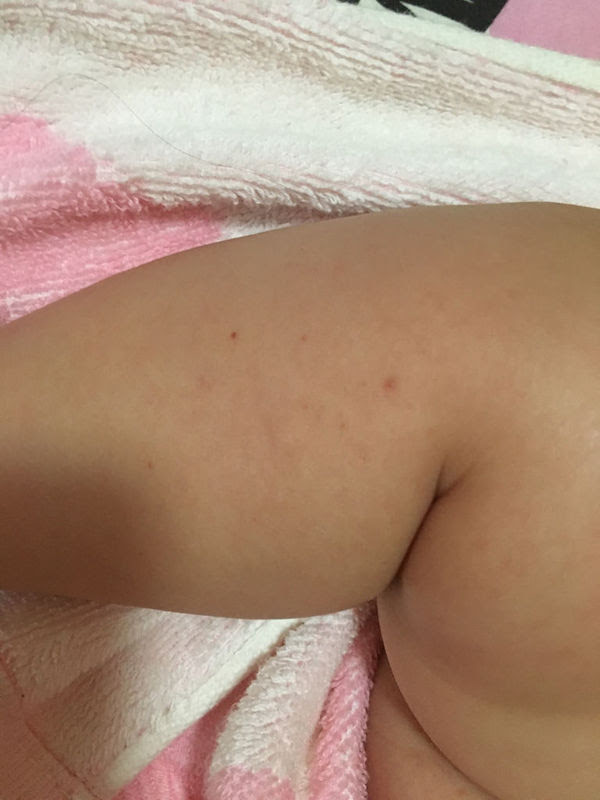 正常皮下出血点图片_万图壁纸网