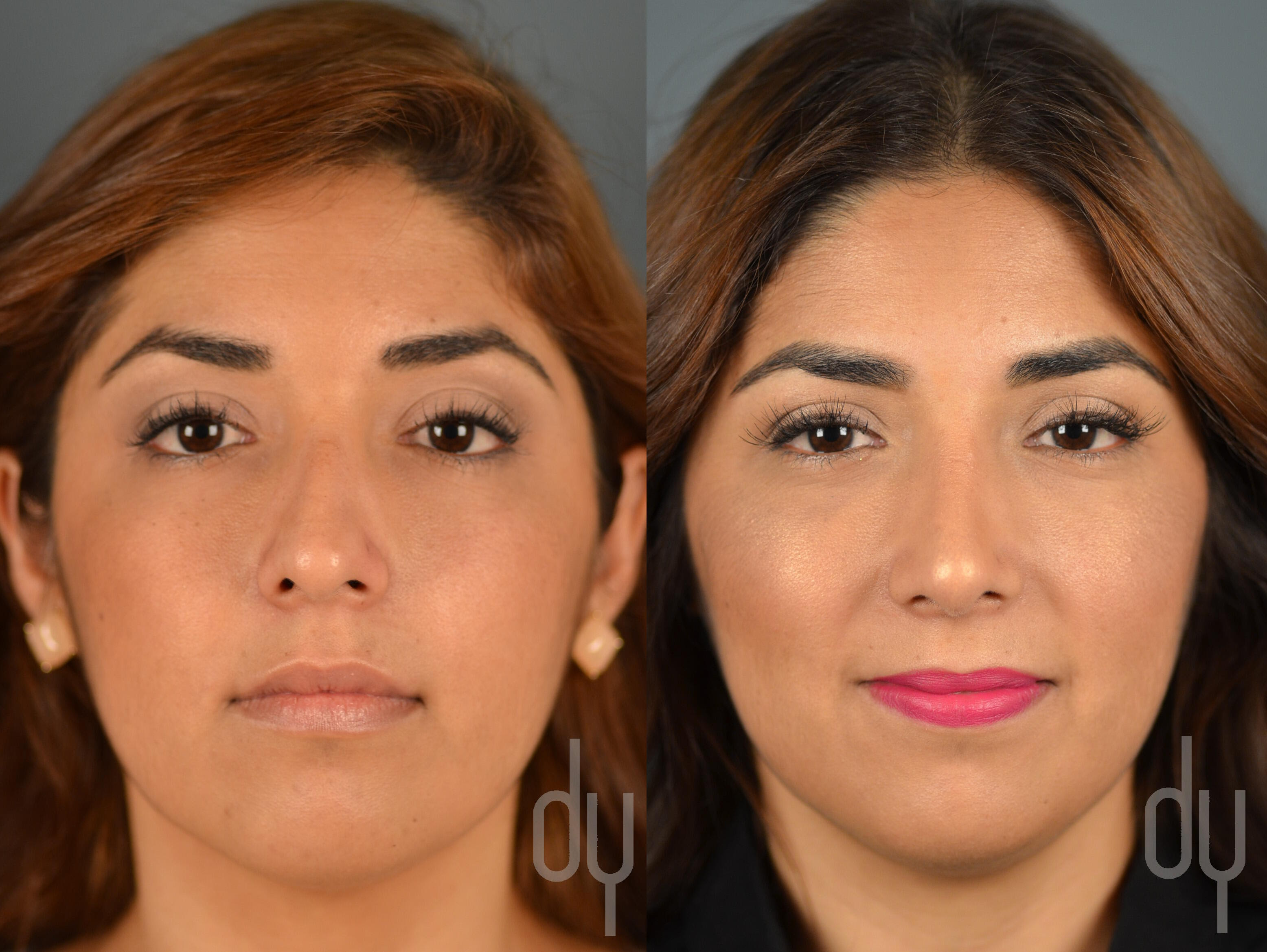 Rhinoplasty | Nose Job Recovery with Rhinoplasty ...