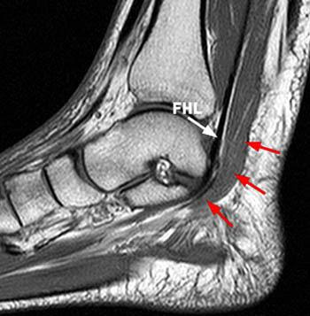 Accessory Muscles of the Ankle - Radsource