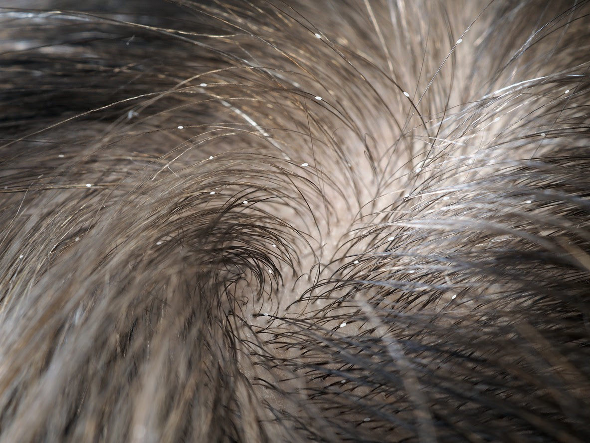 Does Blonde Hair Dye Kill Lice