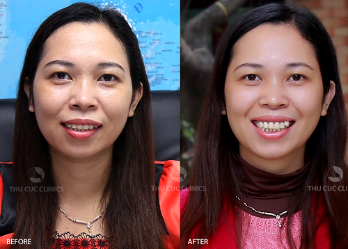 Làn da của chị Bích Vân (Hà Nội) như được tái tạo và trở nên cămg mịn, sáng sau khi trải nghiệm dịch vụ làm đẹp P’cell Thu Cúc Clinics.