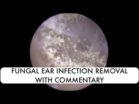 Fungal ear infection