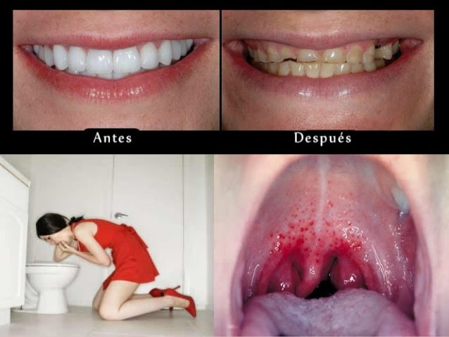 anorexiadientes