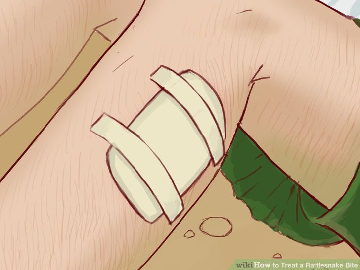 Treat a Rattlesnake Bite Step 8.jpg