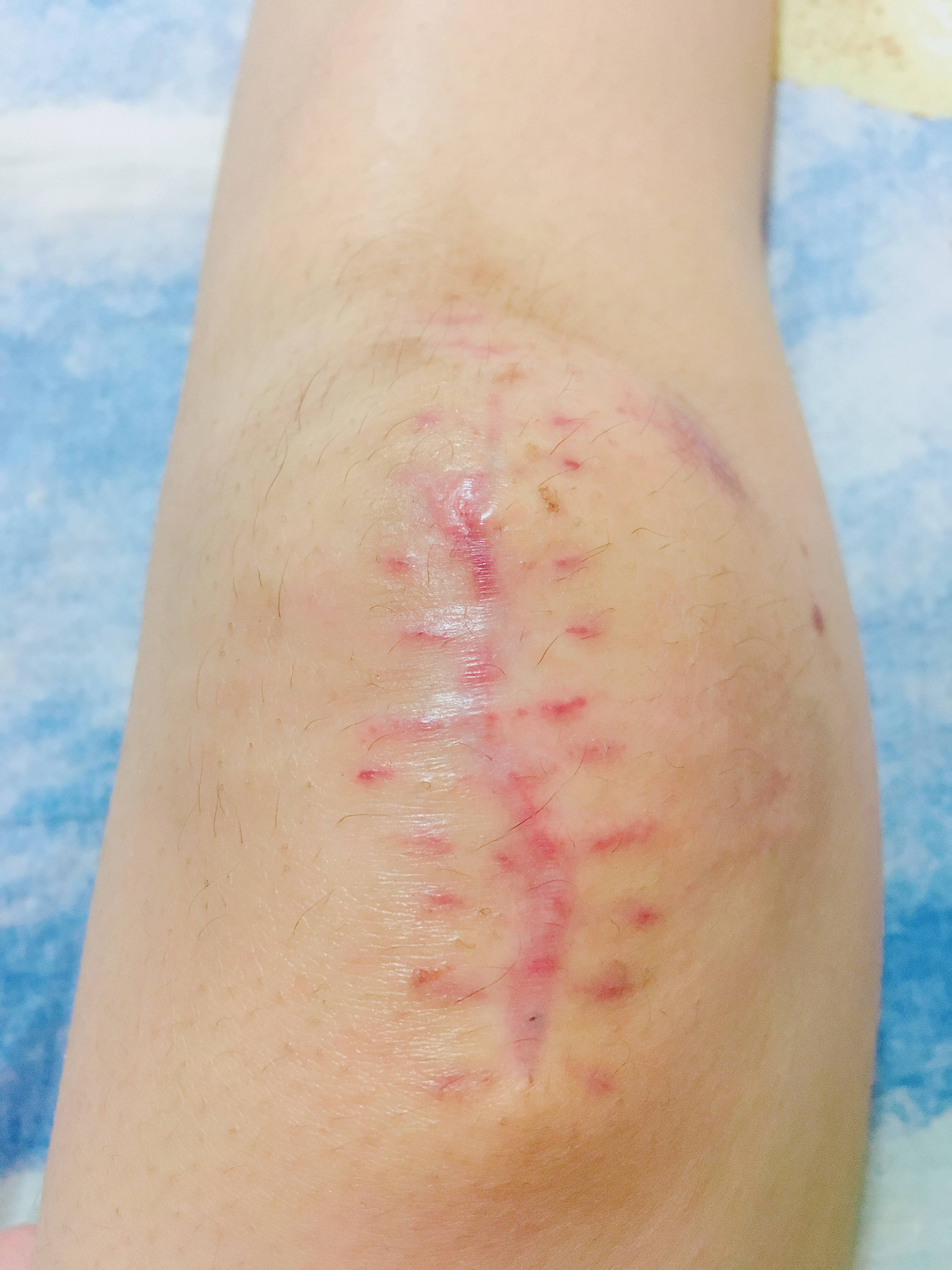 問題 拆線有多痛 Womentalk板 Disp s