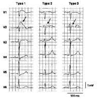 Three types of ST-segment elevation in Brugada syn