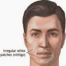Vitiligo atau Sopak adalah salah satu penyakit autoimmune