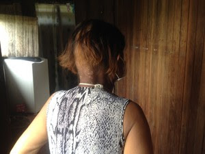 Radioterapia deixou mulher com perda de cabelo (Foto: Abinoan Santiago/G1)