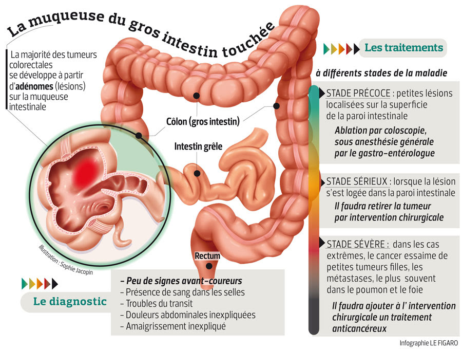 most cancers du pancreas purpose