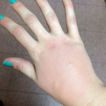 ... South Haven - South Haven, MI, United States. Swollen Bed Bug Bites