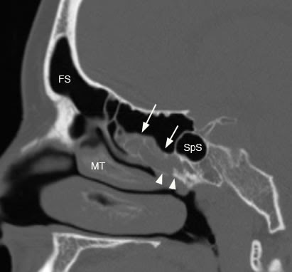 Ethmoid Sinus Abnormal